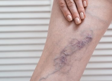 Deep Vein Thrombosis
