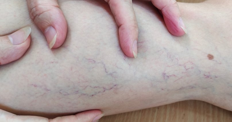 Varicose Vein Treatment